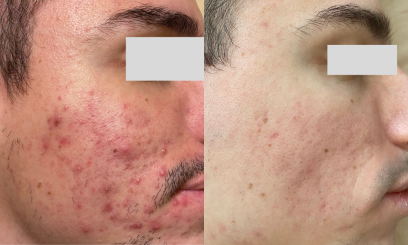 Пилинг Джесснера 2